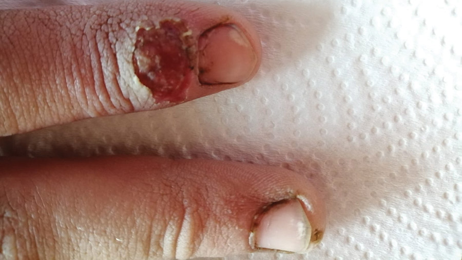 Fingers showing infection